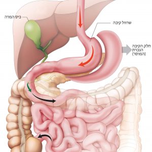 ניתוח שרוול – Sleeve Gastrectomy