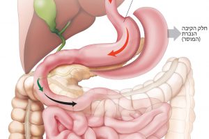 ניתוח שרוול – Sleeve Gastrectomy