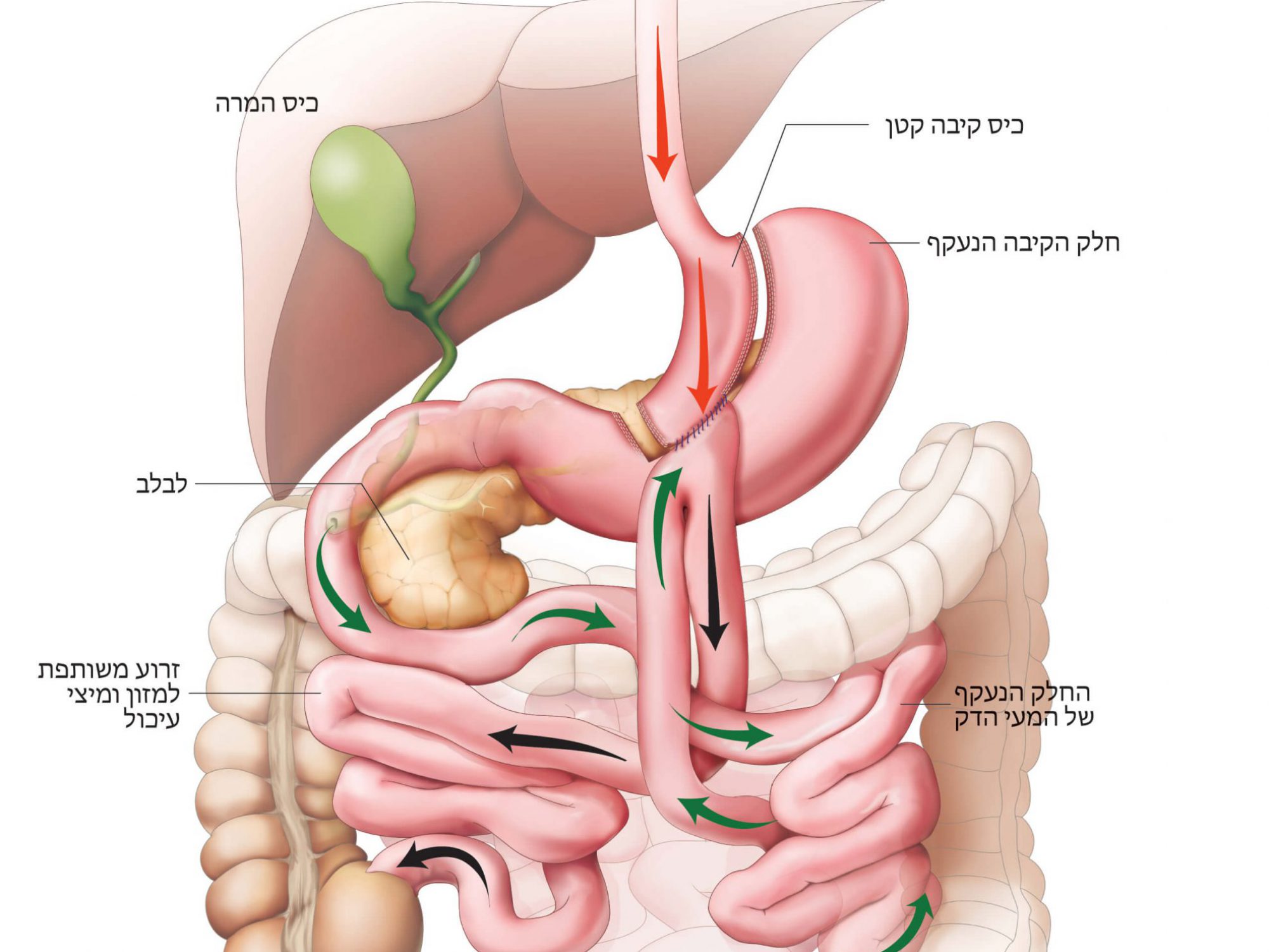 מעקף קיבה בהשקה אחת (מיני מעקף) – One Anastomosis Gastric Bypass