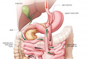 מעקף קיבה בהשקה אחת (מיני מעקף) – One Anastomosis Gastric Bypass